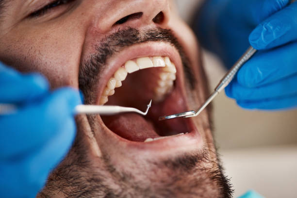 Best Knocked-Out Tooth (Avulsed Tooth) Treatment in Mill Neck, NY